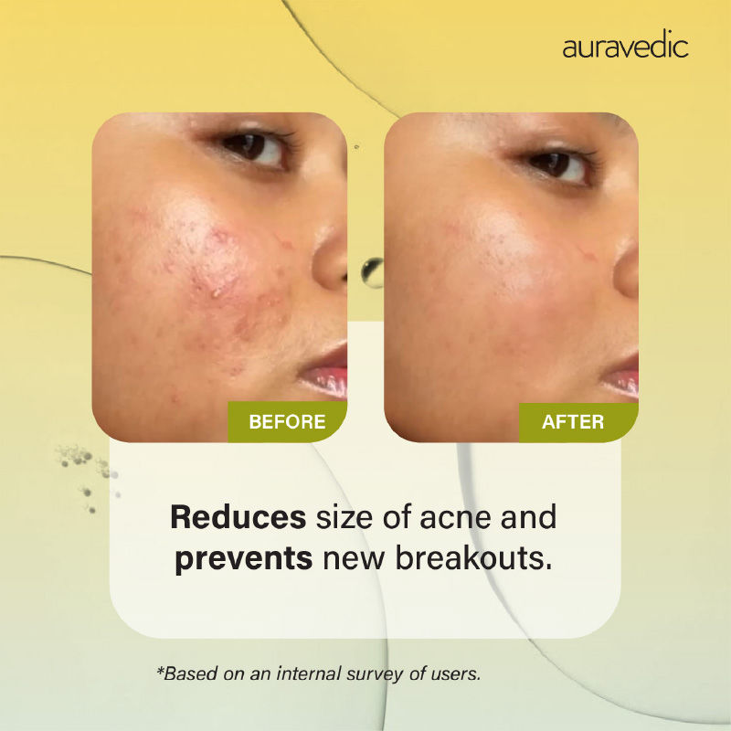 Auravedic Tea Tree Oil Salicylic acid Face Serum for Acne Prone Skin Pore Minimizing Serum