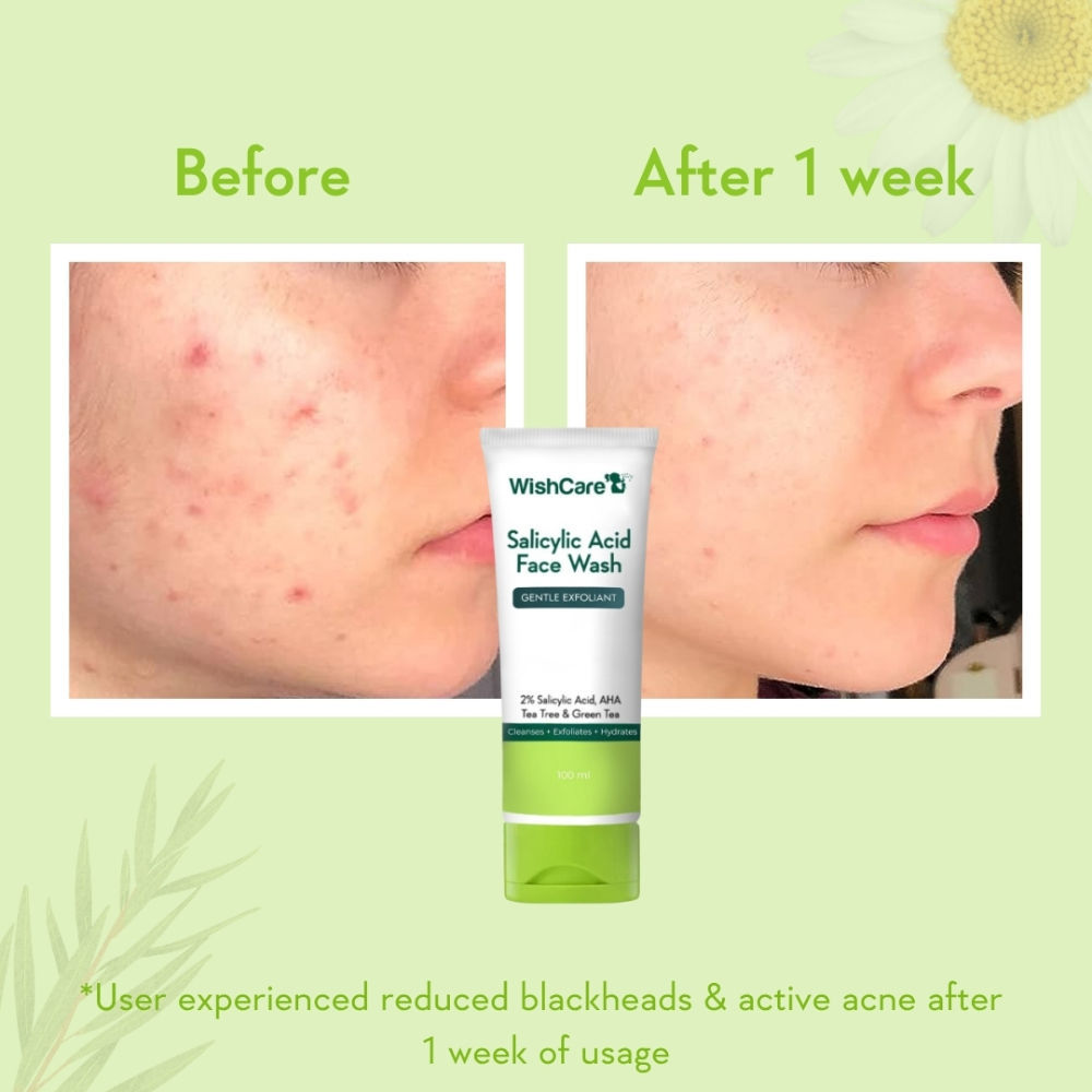 WishCare 2% Salicylic Acid Face Wash with AHA, Greentea & Tea Tree -Oil Control-Reduces Sebum & Acne
