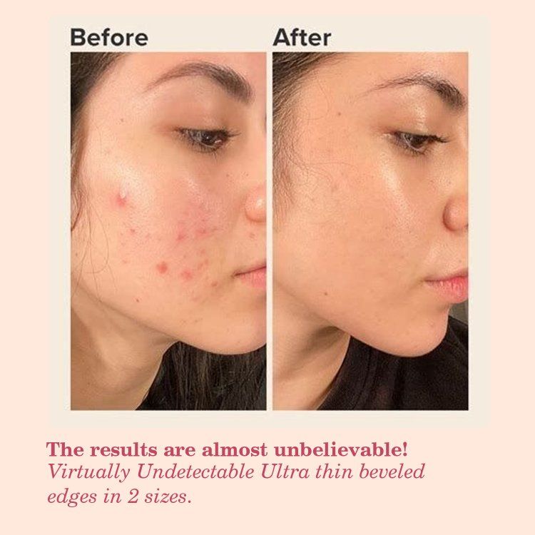 WILDGLOW Acne Pimple Patches