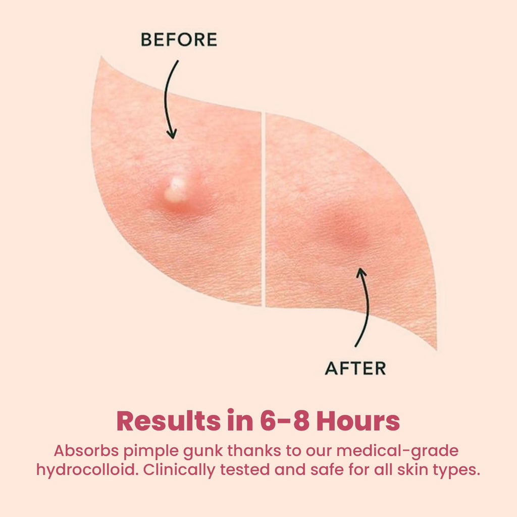 WILDGLOW Acne Pimple Patches