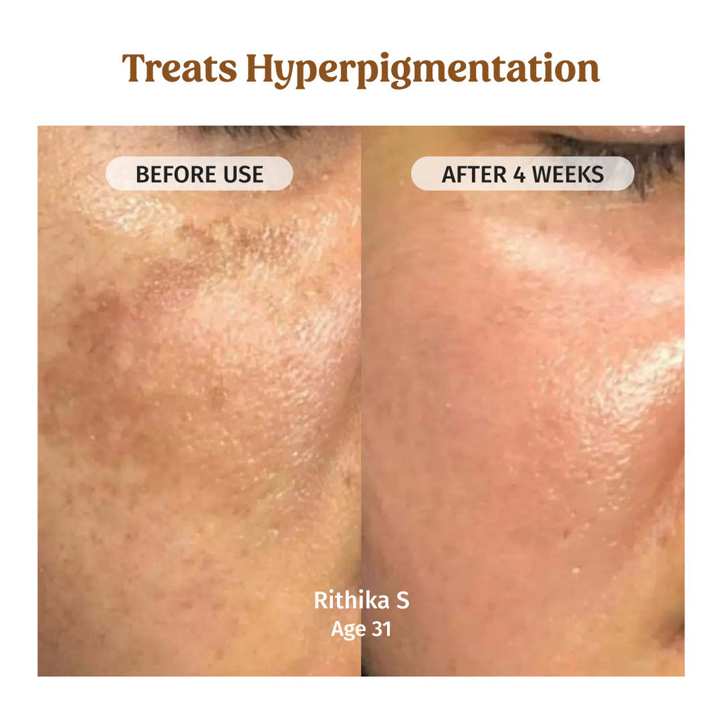 VILVAH Milk Drops Skin Brightening Serum With Rice Milk, Marine Algae Extract & Alpha-Arbutin