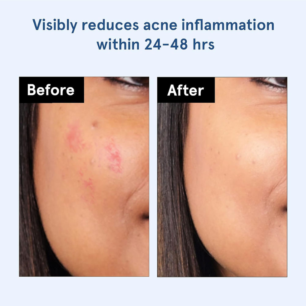 Be Bodywise Hydrocolloid Acne Pimple Patch Absorbs & Flattens Acne Overnight