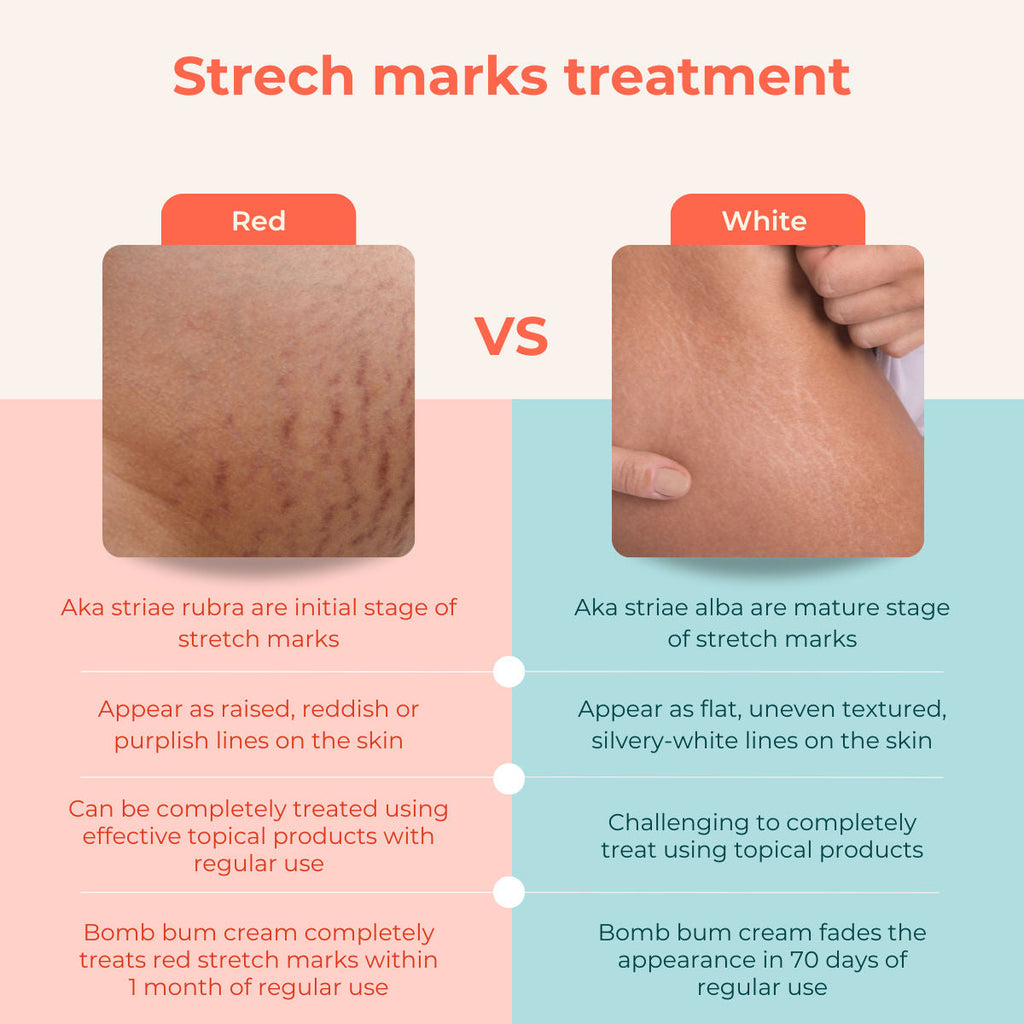 Skinvest Bomb bum cream for Stretch Marks + Cellulite
