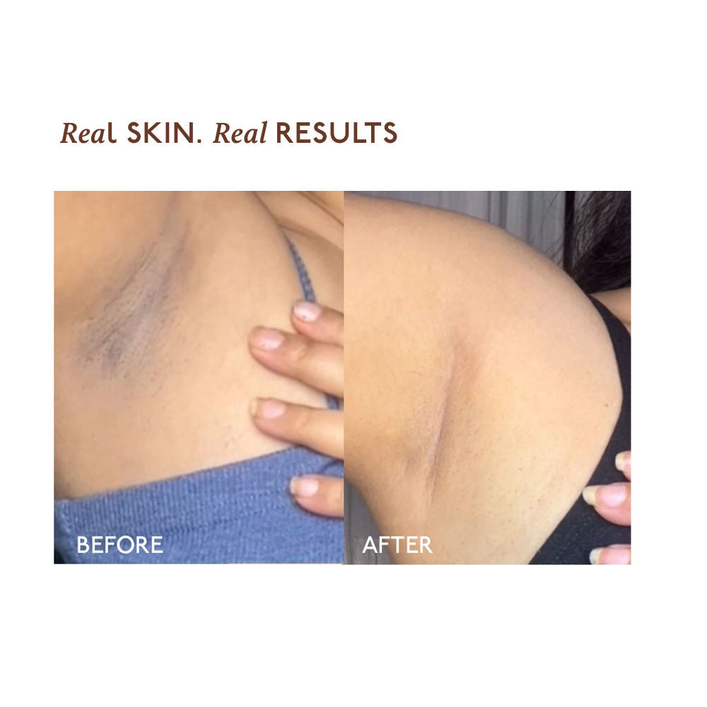 Asaya Depigmentation Underarm Spray for Dark Underarms with MelaMe Complex