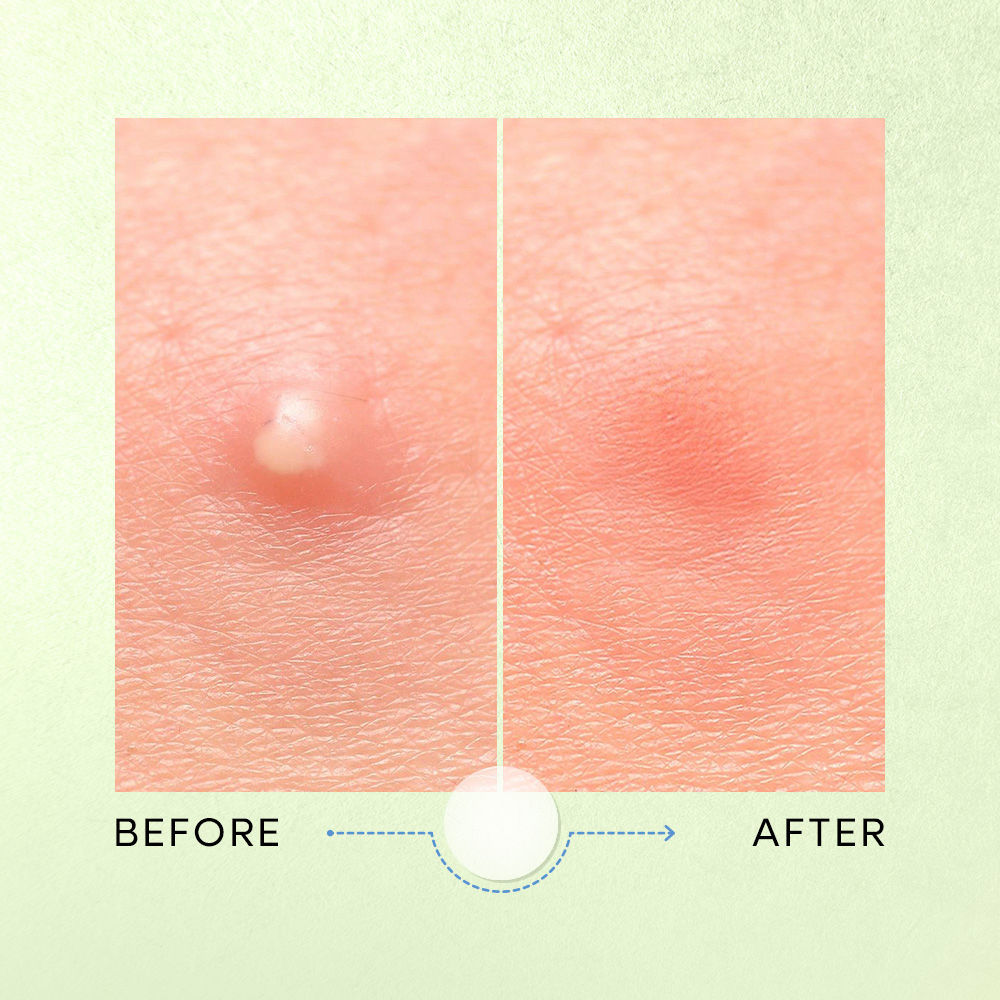 Nykaa Skin Secrets Tea Tree & Salicylic Acid Korean Acne Spot Patch-Fast Acne Healing (12 pcs)