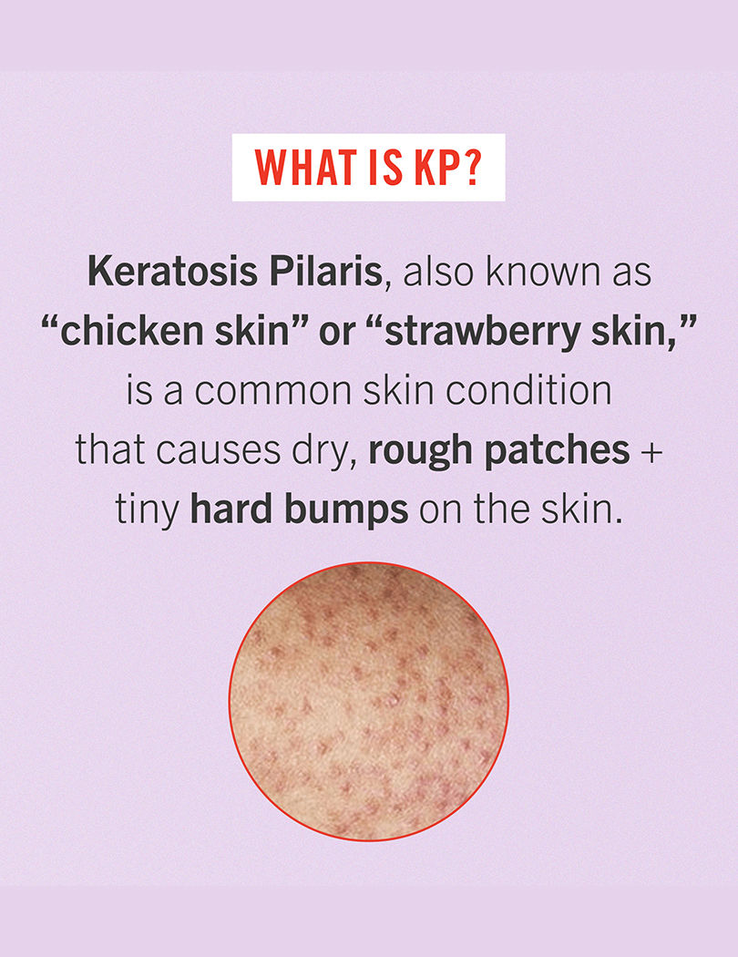 First Aid Beauty KP Bump Eraser Body Scrub With 10% AHA