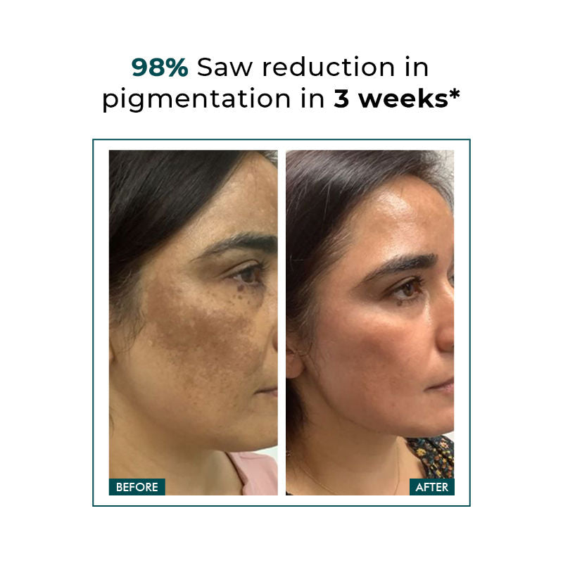 Conscious Chemist Pigmentation Corrector Cream For Dark Spots Remover & Uneven Skin Tone