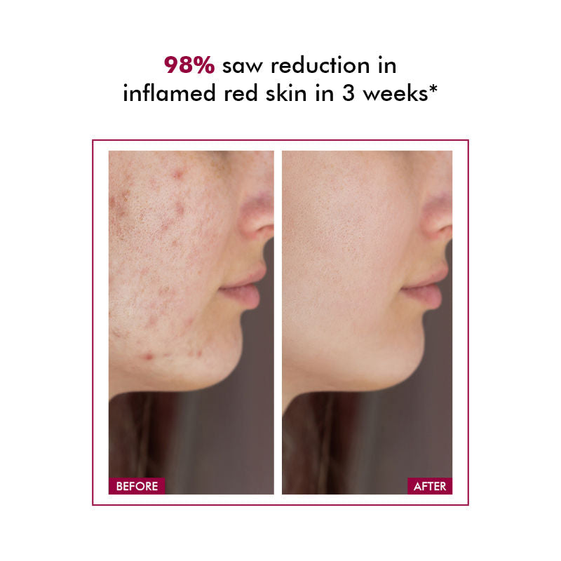 Conscious Chemist 10% Azelaic Acid Gel Cream For Redness Relief & Acne Treatment
