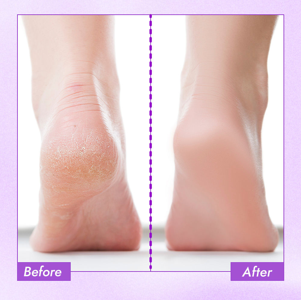 Nykaa Skin Happy Heels 20%Urea, 2%Lactic Acid Foot Cream-Dry & Cracked Feet
