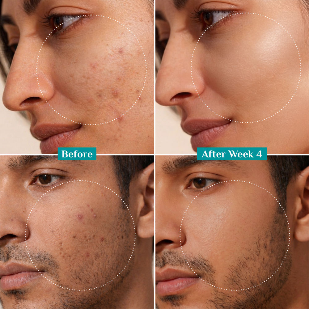 Pilgrim 10% Niacinamide Face Serum For Acne Marks