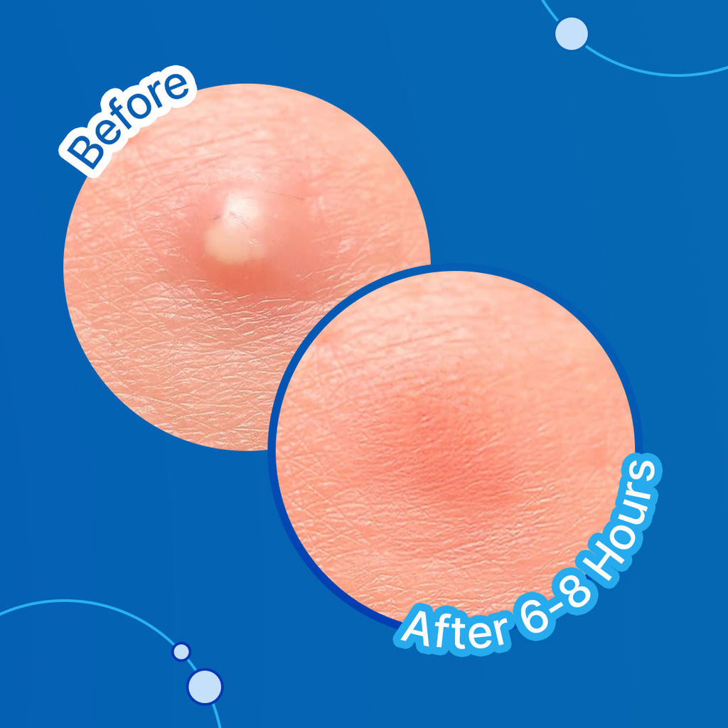 Sotrue Acne Patches With Salicylic Acid And Hydrocolloid For Clean & Clear Skin - 20 Patches