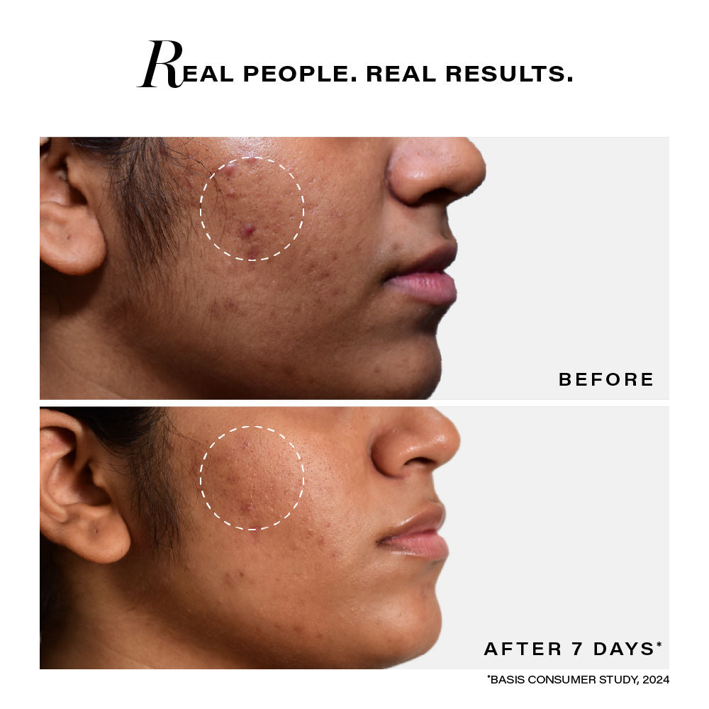 Novology Acne Clearing Serum with Thymol And Terpineol|Non Drying|Non Irritating