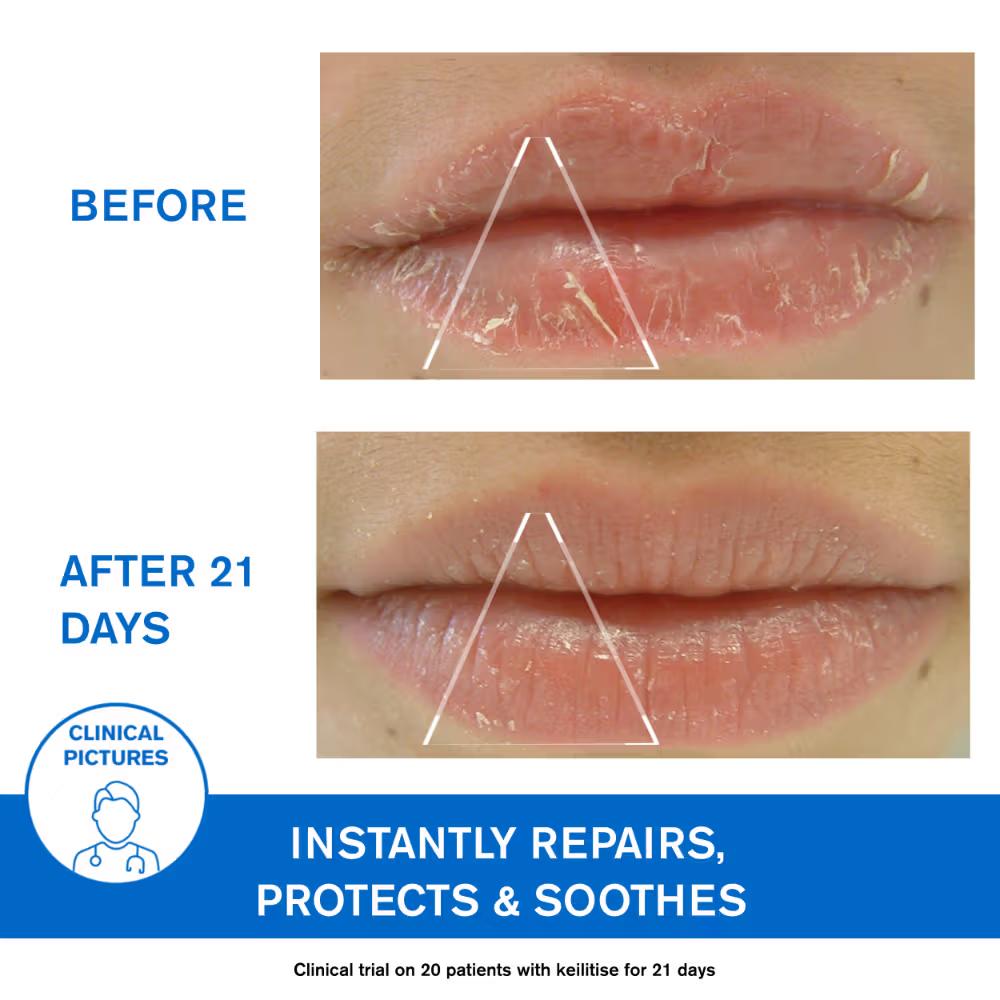Uriage Bariederm-Cica Protecting Dermat Recommended Lip Balm Repairs Soothes Chapped Damaged Lips
