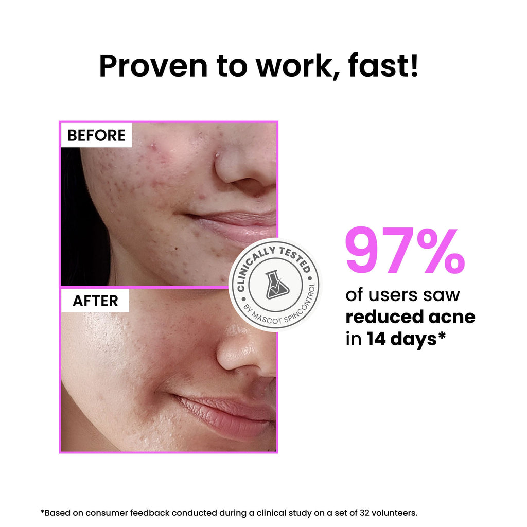 Foxtale 12% Niacinamide Brightening Face Serum, Fades Dark Spots, Acne marks & Oil Control