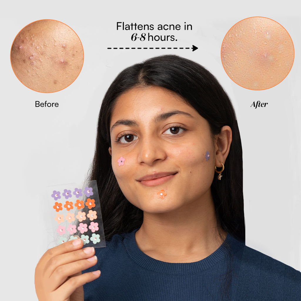 Gush Beauty Dart It Hydrocolloid Pimple Patches
