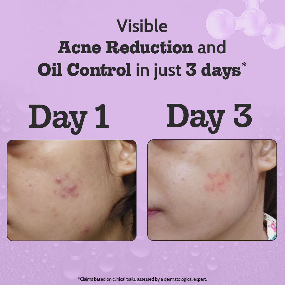 Chemist at Play 2% Salicylic Acid Face Serum Treats Active Acne, Controls Excess Oil