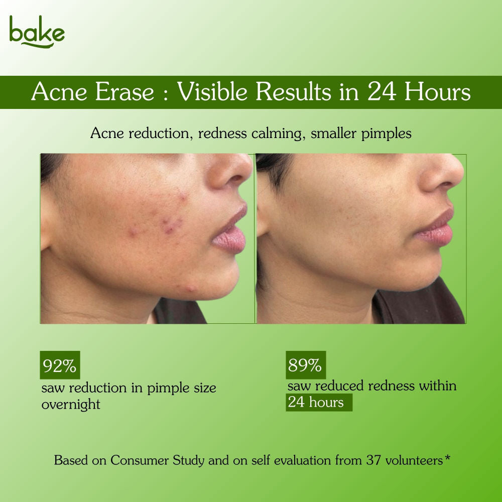 BAKE Acne Spot Serum Gel - Overnight Corrector For Pimples, Breakouts, Redness & Clogged Pores