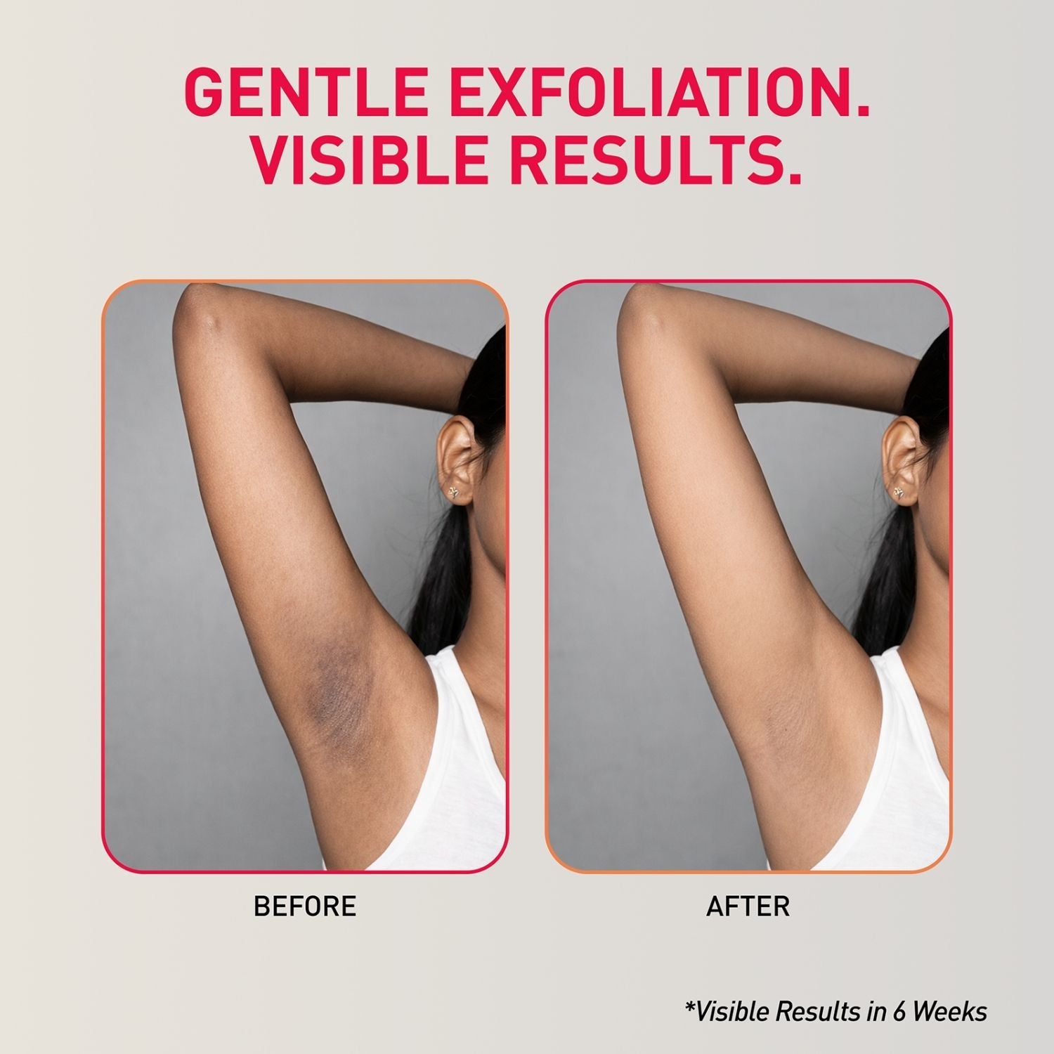 Sirona 7% AHA BHA Underarm Mist, Treats Pigmentation & Odour - Lactic, Mandelic & Salicylic Acid