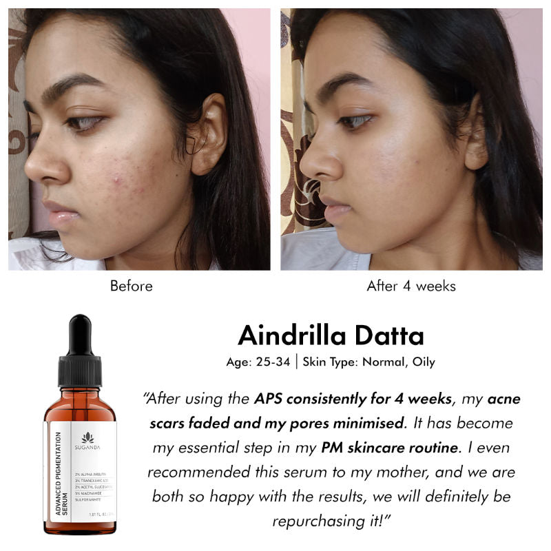 Suganda Advance Pigmentation Face Serum with Arbutin +Tranexamic Acid, Fights Hyperpigmentation