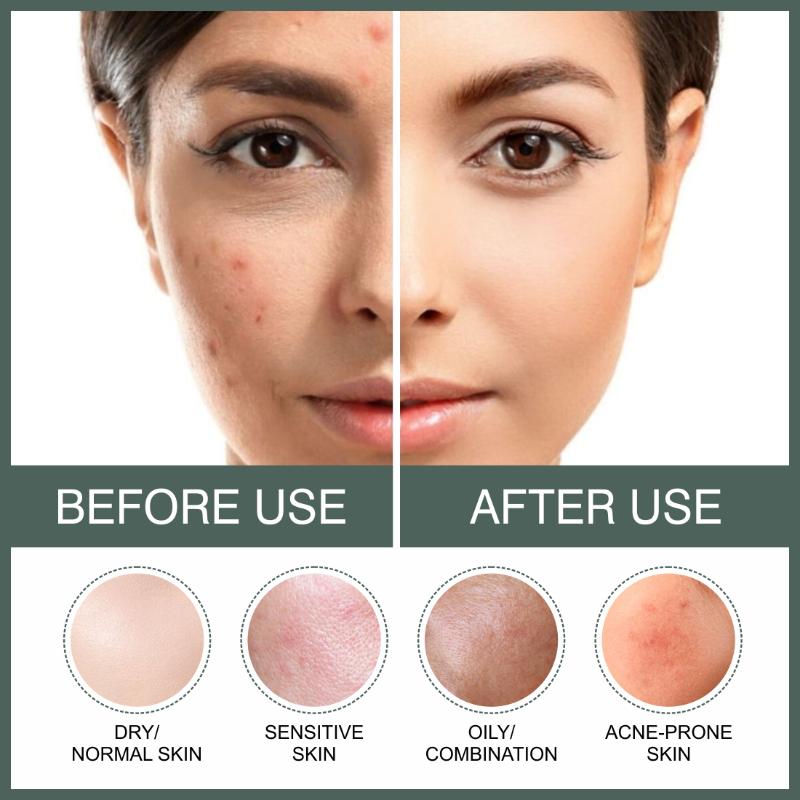 She Essentials 2% Salicylic Acid Serum For Face For Active Acne