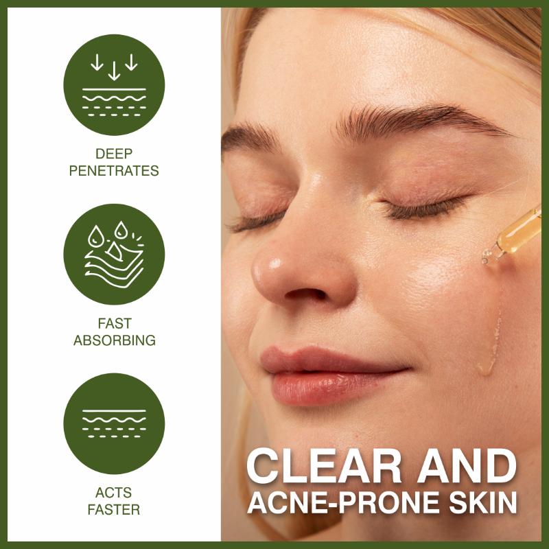 She Essentials Anti-Acne Face Oil Serum With Tea Tree Oil