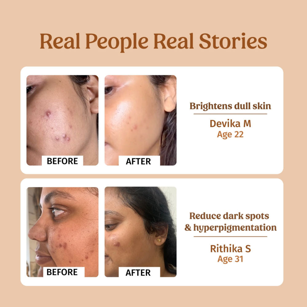Vilvah Milk Drops Brightening Serum For Hydrated Skin, Dark Spot Care & Hyperpigmentation
