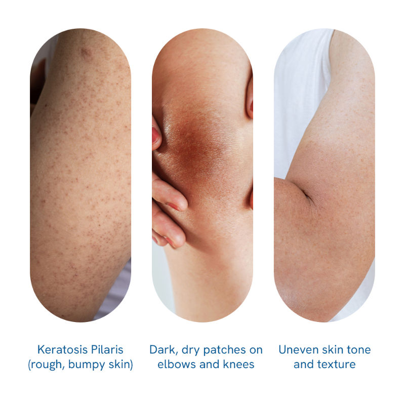 Be Bodywise 5% Lactic Acid Body Lotion - For 24H Moisturization, Improved Skin Texture, Smooth Skin