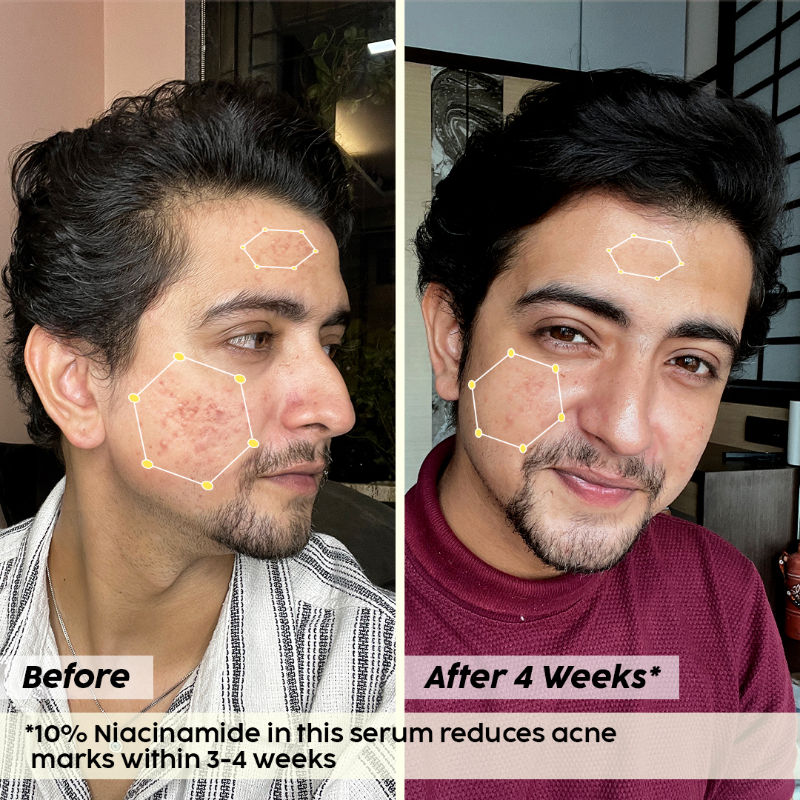 Plix 10% Niacinamide Jamun Face Serum for Acne marks, blemishes & oil control