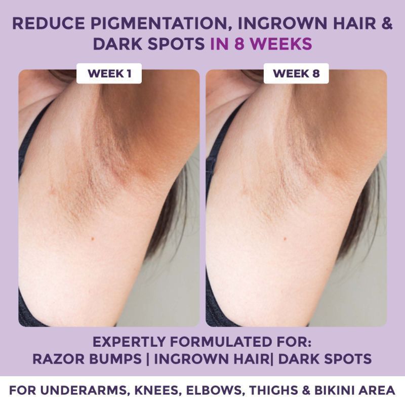 Sanfe Spotlite Ingrown Hair & Bumps Clearing Body Scrub For Dark Underarms, 10% Glycolic Acid