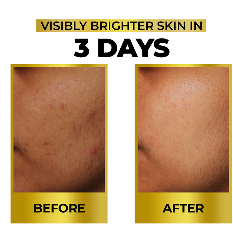 Streax Bright & Shine Face Serum For Brightening, Dark Spots Reduction