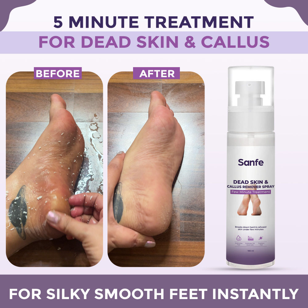 Sanfe Dead Skin & Callus Remover Spray | Freshens, Exfoliates - For dry & cracked feet, 100ml