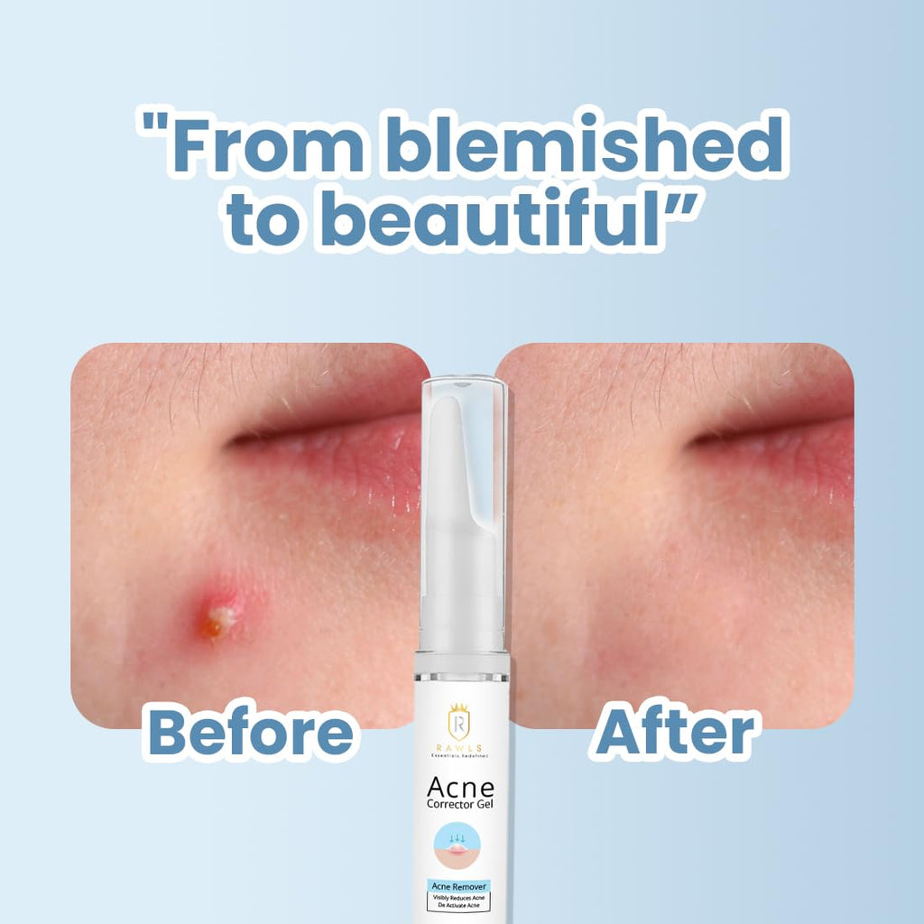 RAWLS Acne Corrector Gel For Active Acne & Redness