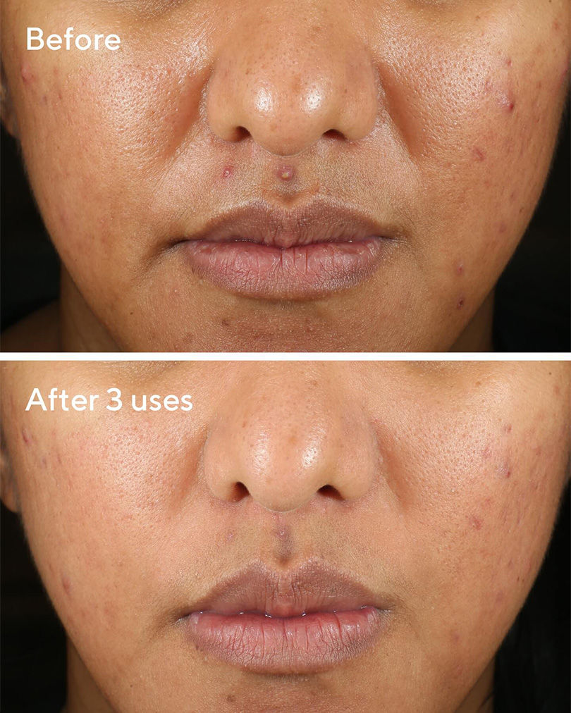 Murad Rapid Relief Sulfur Mask