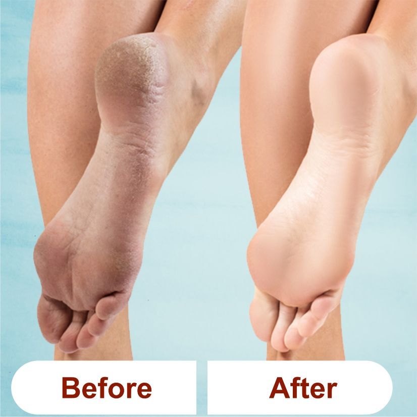 Kazarmaa Tea Tree And Lemon Anti Bacterial Foot Scrub With Jojoba Oil - For Feet Nourishment