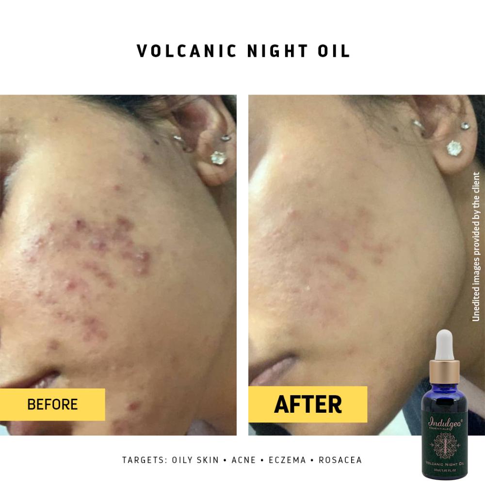 Indulgeo Essentials Volcanic Night Oil For Oily Acne Prone Skin With Tamanu Oil