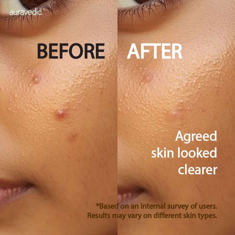 Auravedic Neem & Tea Tree Face Wash For Oily And Acne Prone Skin Tea Tree Oil Salicylic Face Wash