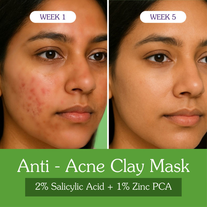 BAKE 2% Salicylic Acid + 1% Zinc PCA Clay Mask for Anti-Acne, Open Pores, and Blackheads