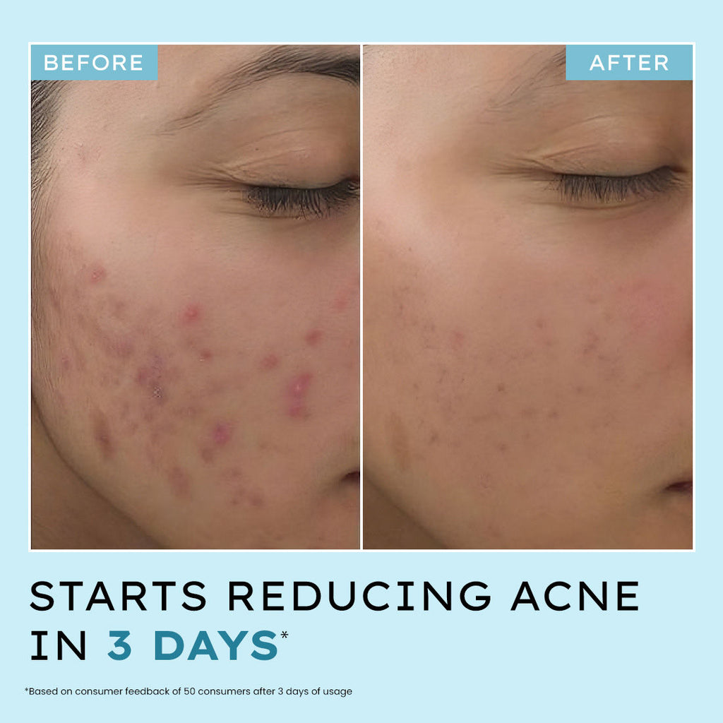 Hyphen Anti Acne 10% Azelaic Acid 2% Salicylic Acid Face Serum, Tea Tree Extract, Fades Acne Marks