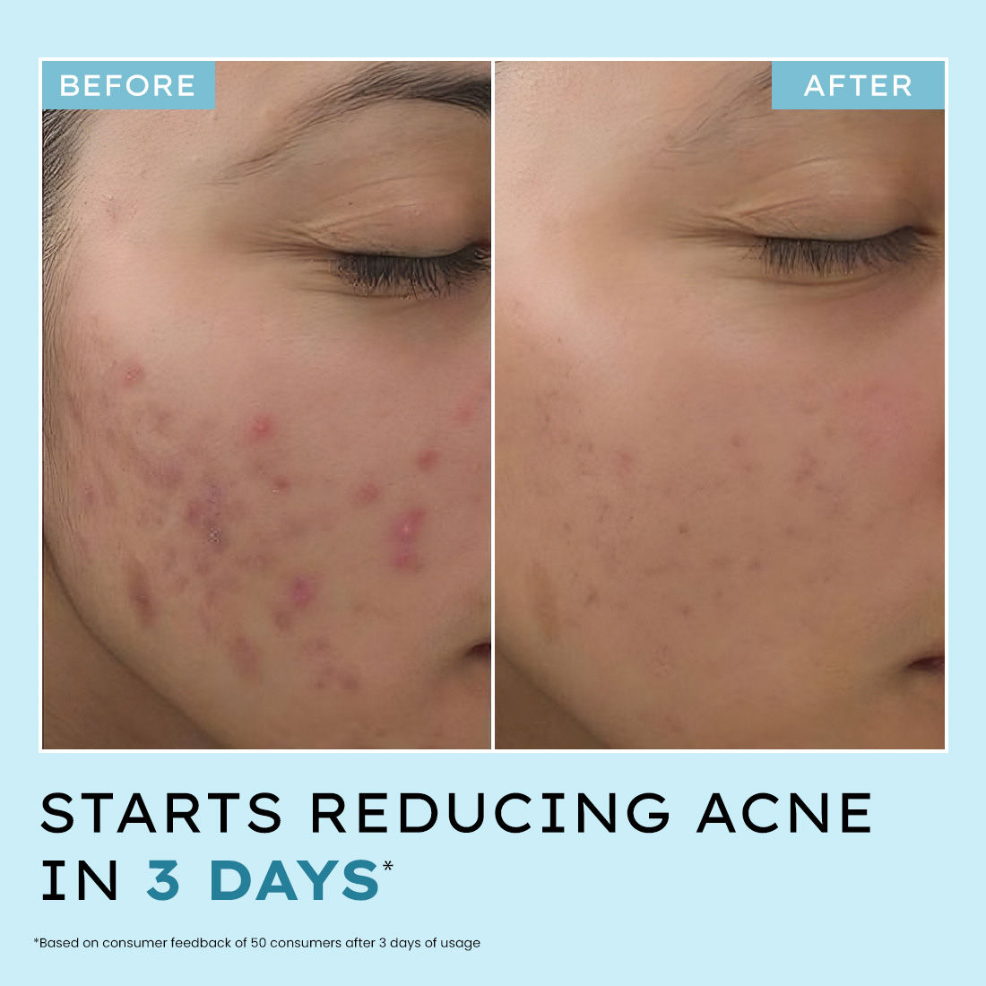 Hyphen Anti Acne 10% Azelaic Acid 2% Salicylic Acid Face Serum, Tea Tree Extract, Fades Acne Marks