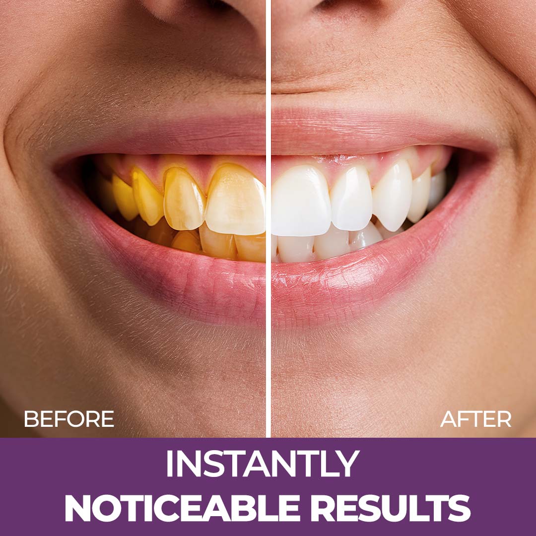 Sanfe Purple Teeth Whitening Gel, Colour Corrector For Yellow Teeth, Dental Whitening Serum