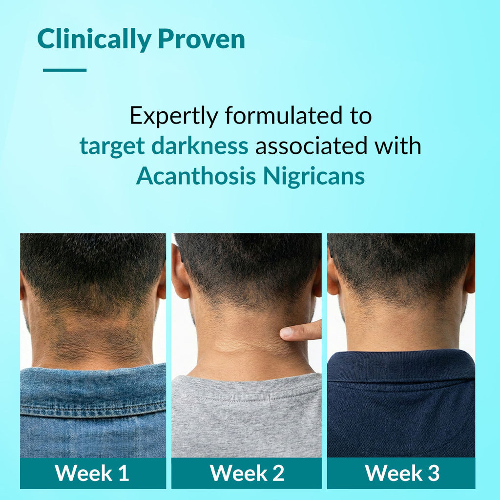 Fixderma Nigrifix Advance Cream for Acanthosis Nigricans with Melatonin, Dermatologist Tested