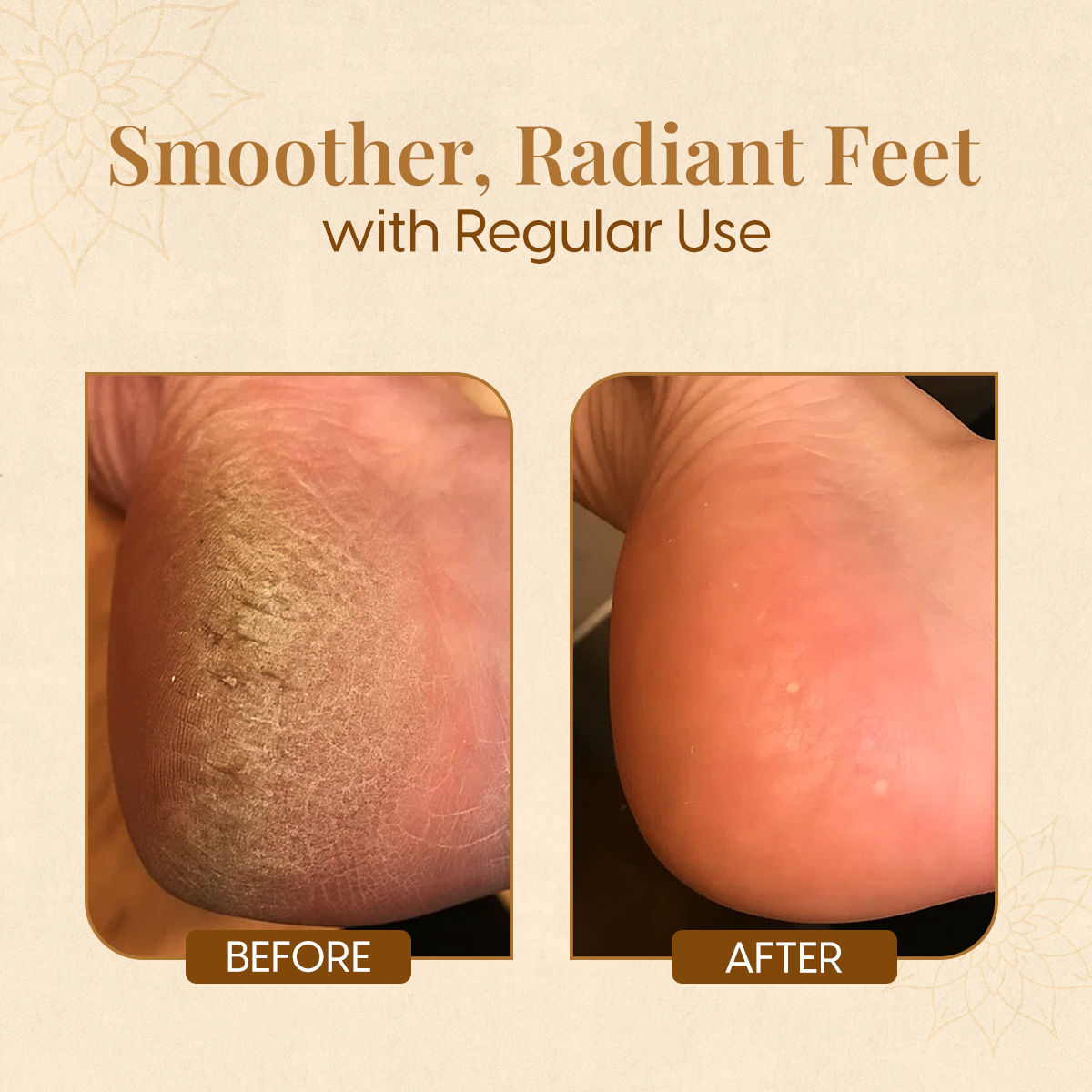Matra Foot Cream for Cracked Heels & Dry Feet with Moisturising Silicone Cotton Socks Callus Repair