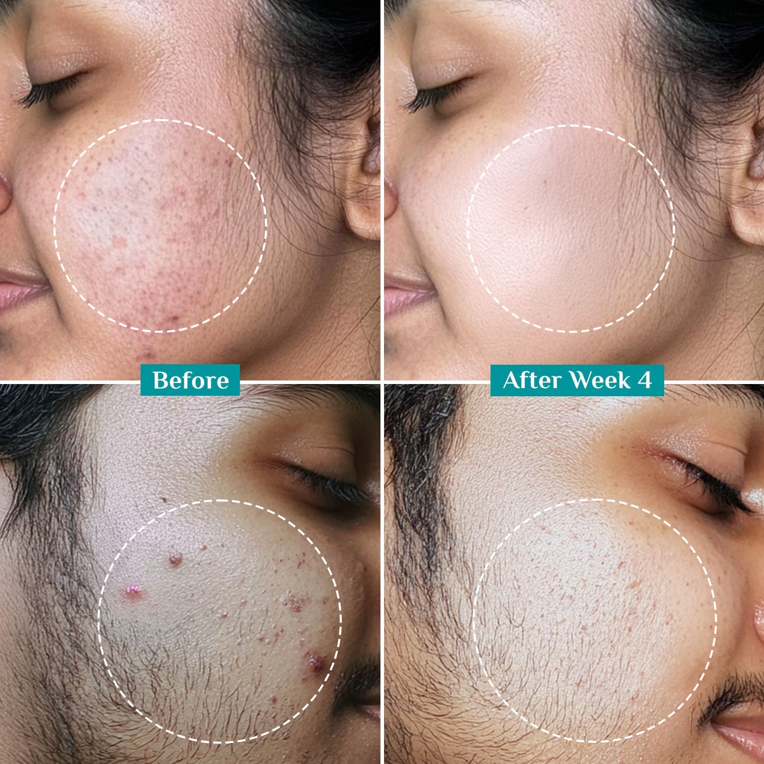 Pilgrim Salicylic & Glycolic Acid Anti Acne Serum