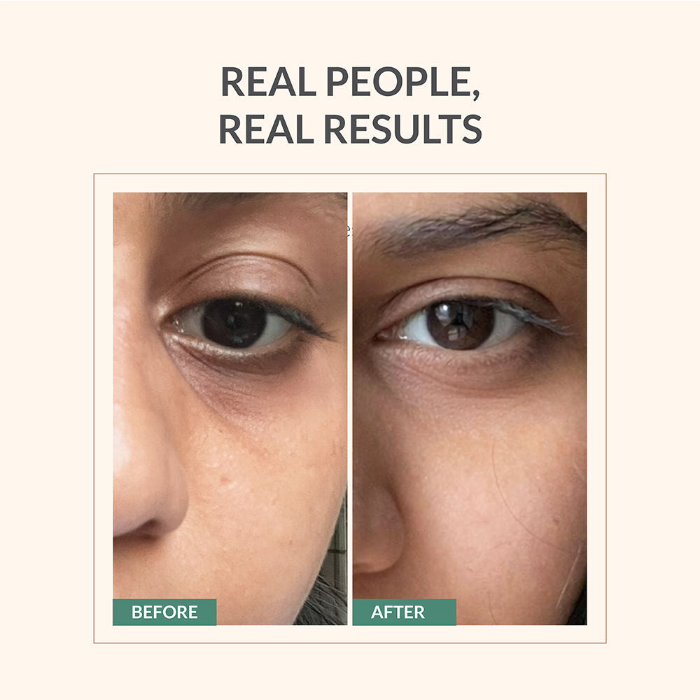 AreoVeda Under Eye Serum, Quinoa Seed Extract & CryoCoffee, Visibly Reduces Dark Circles, Puffiness