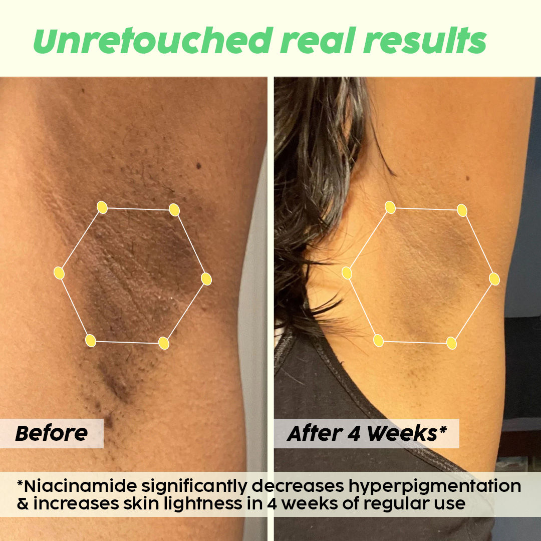 PLIX Pineapple Underarm Depigmentation Spray, For Lightening, Hyperpigmentation, Odour protection