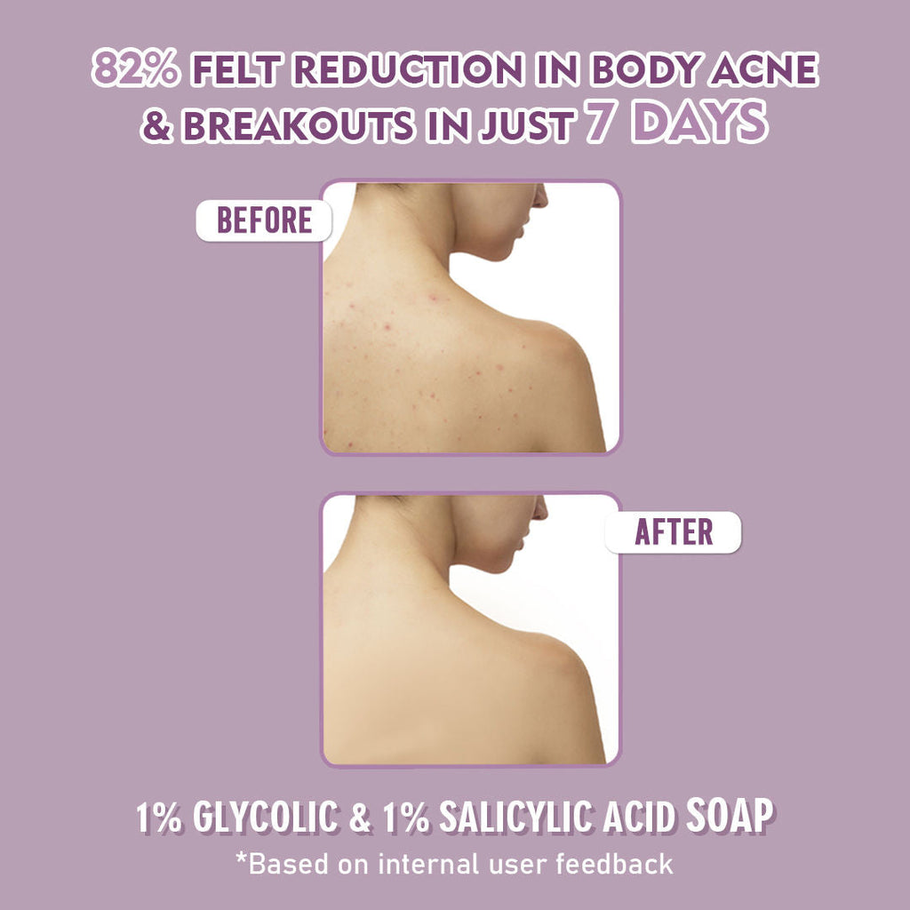 Glamveda 1% Glycolic Acid & 1% Salicylic Acid Body Acne Soap