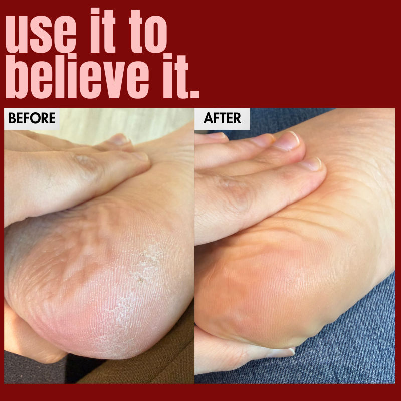 Hibiscus Monkey The Foot Balm For Dry Feet & Cracked Heels