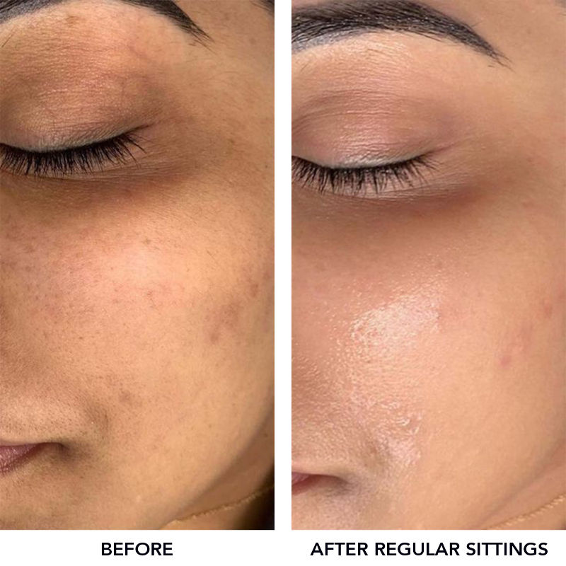 O3+ Meladerm Vitamin C Gel Bleach For Dullness Removal, Hydration & Glowing Skin, All Skin Types