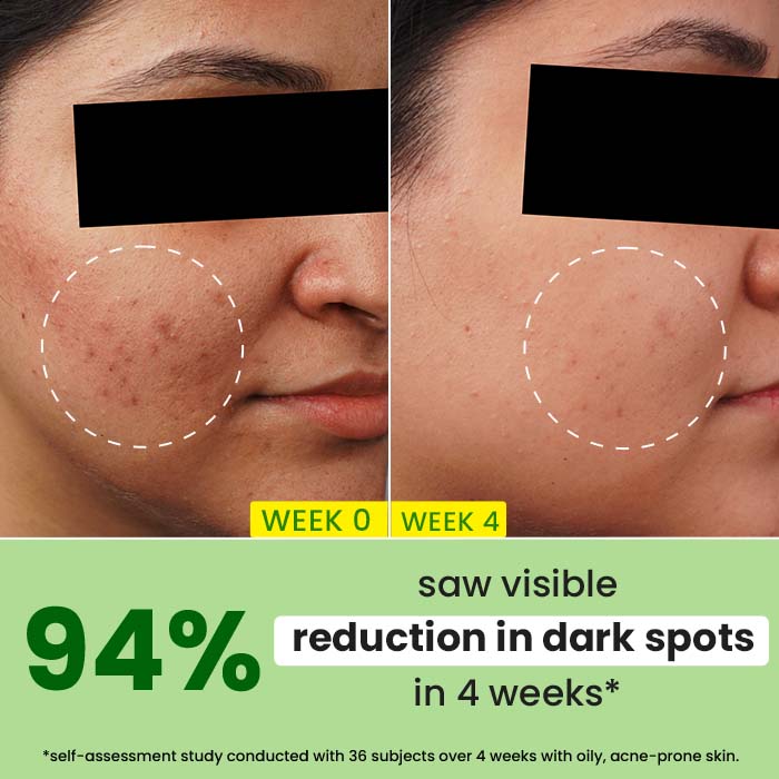 Dot & Key 10% Niacinamide + Cica Face Serum For Oily, Acne Prone Skin & Dark Spots Reduction