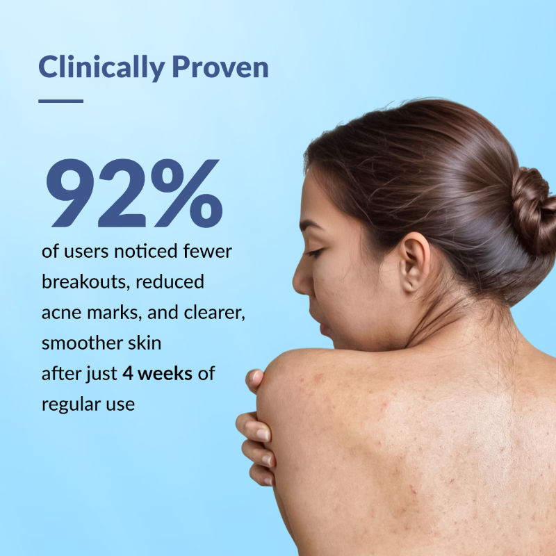 Fixderma 2% Salicylic Acid + 2% Azelaic Acid Salyzap AZ Acne Body Spray For Back & Upper Arms